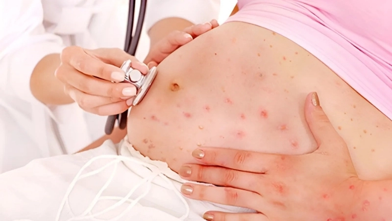 Triệu chứng khi bị zona khi mang thai