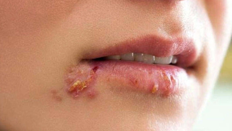 Mẹo và biện pháp chữa trị khi bị zona khi mang thai