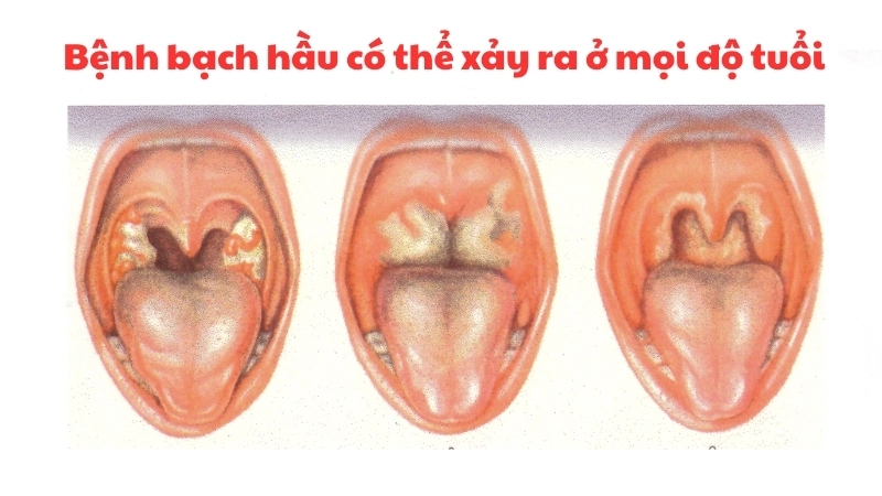 Bệnh bạch hầu có thể xảy ra ở mọi độ tuổi