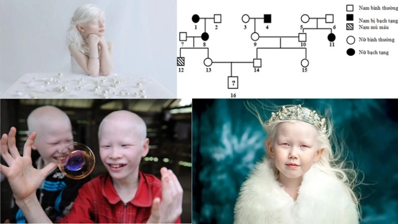 Bị bạch tạng có sao không?