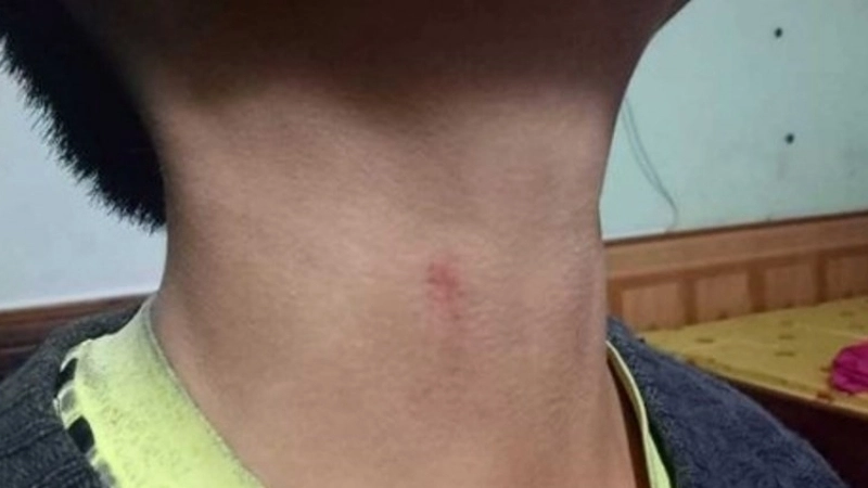 Bị bóp cổ có sao không?