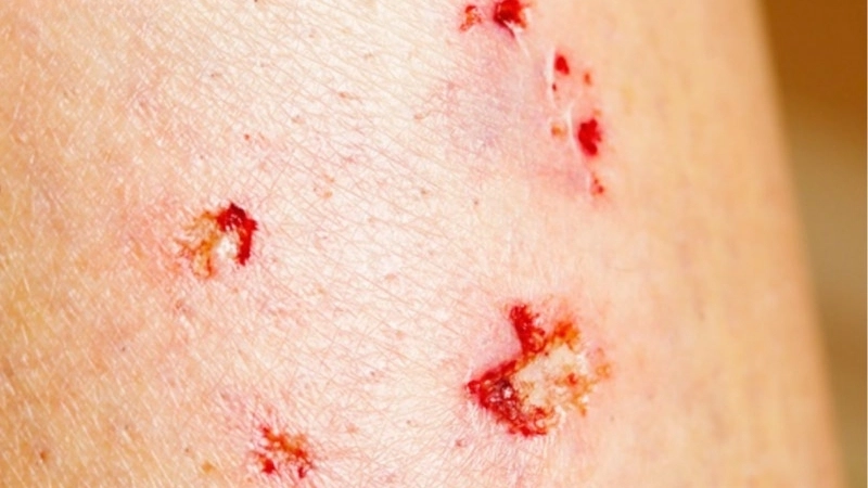 Triệu chứng khi bị dơi cắn