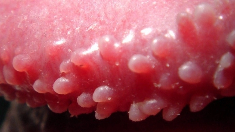 Triệu chứng khi bị hạt ngọc