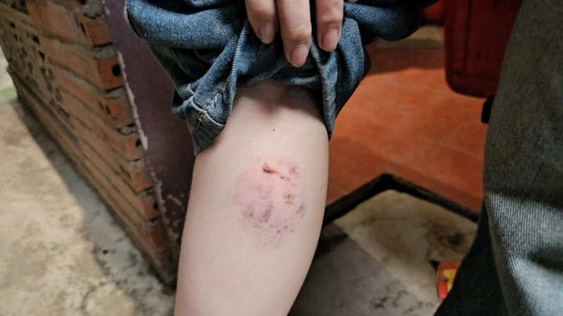 Triệu chứng khi bị khỉ cắn