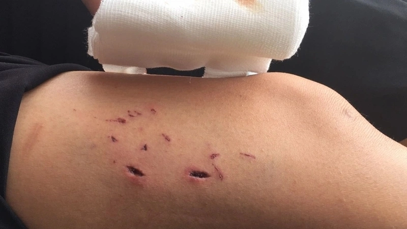 Mẹo và biện pháp chữa trị khi bị khỉ cắn