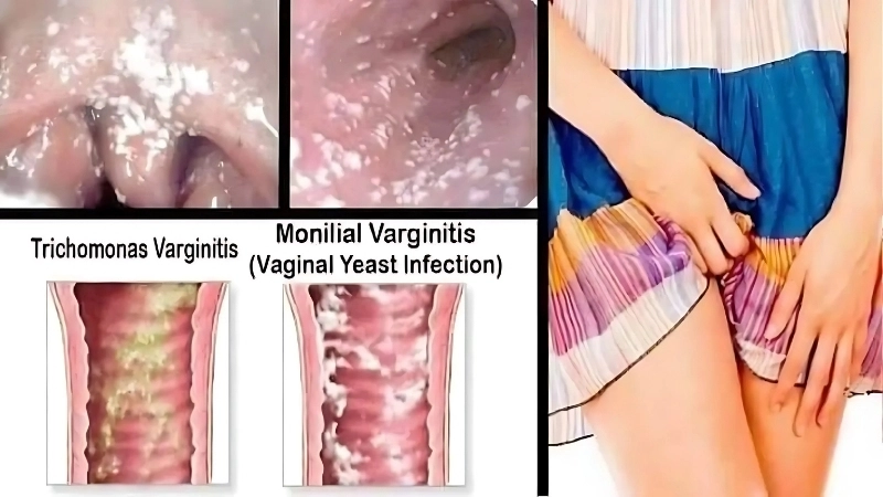 Triệu chứng khi bị nấm candida