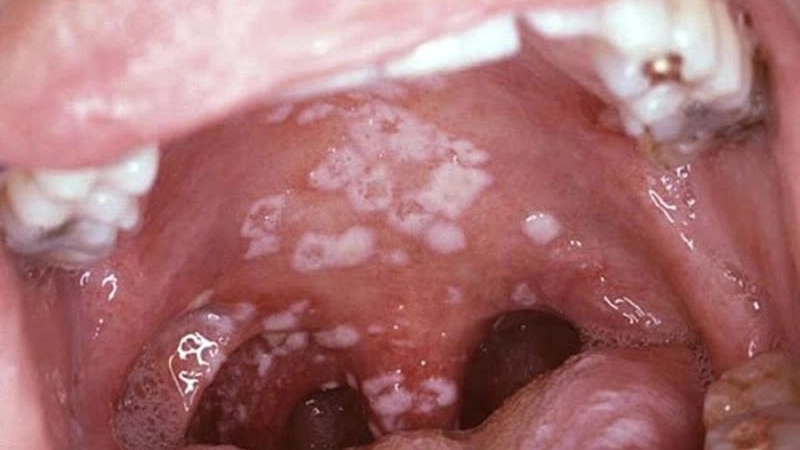 Mẹo và biện pháp chữa trị khi bị nấm candida