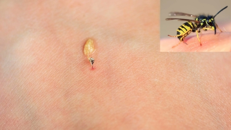 Triệu chứng khi bị ong đốt