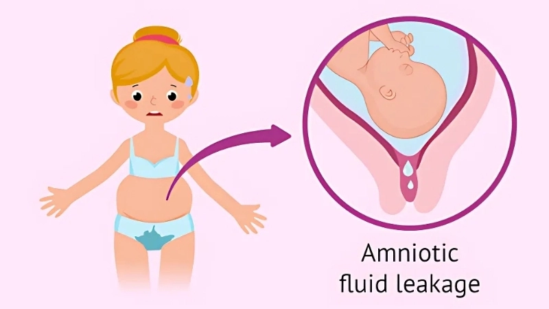 Triệu chứng khi bị rỉ ối