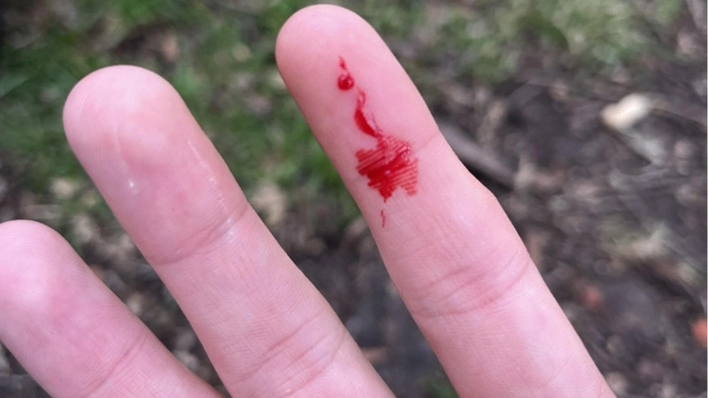 Triệu chứng khi bị sóc cắn