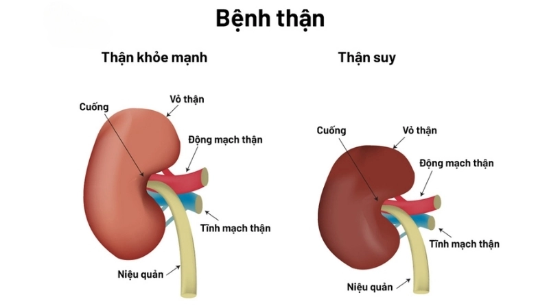 Bị suy thận có sao không?