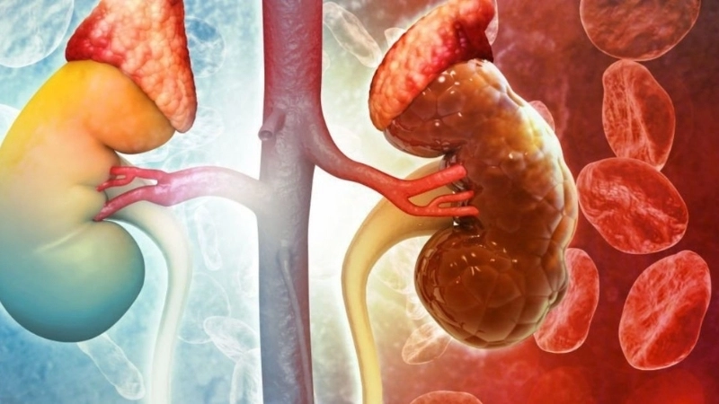 Mẹo và biện pháp chữa trị khi bị suy thận