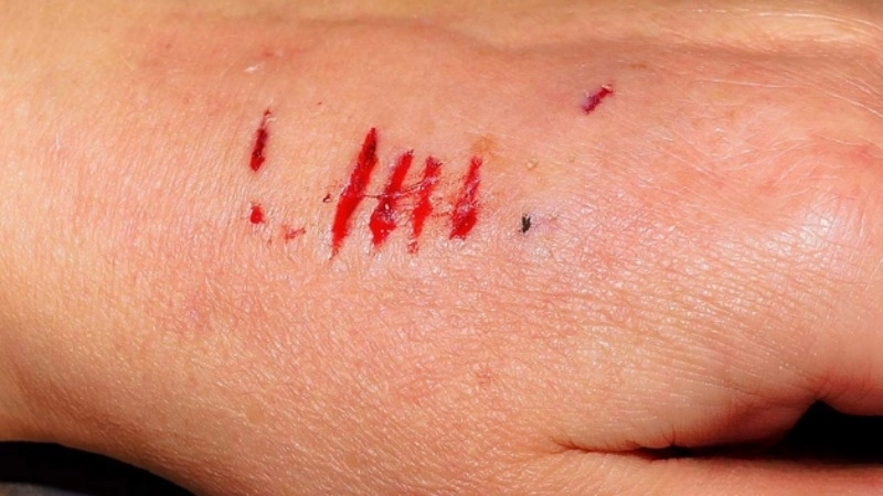 Triệu chứng khi bị thỏ cắn