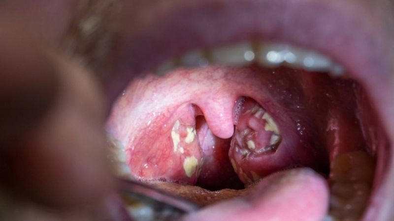 Mẹo và biện pháp chữa trị khi bị viêm amidan