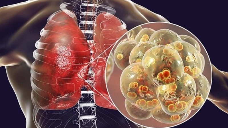 Bị viêm phổi có sao không?