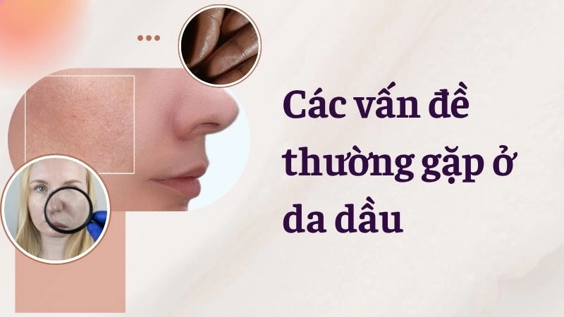 Hình ảnh lỗ chân lông to rõ rệt, dấu hiệu nhận biết da dầu là gì và các vấn đề thường gặp