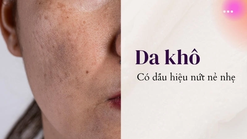 Một làn da căng khô, có dấu hiệu nứt nẻ nhẹ