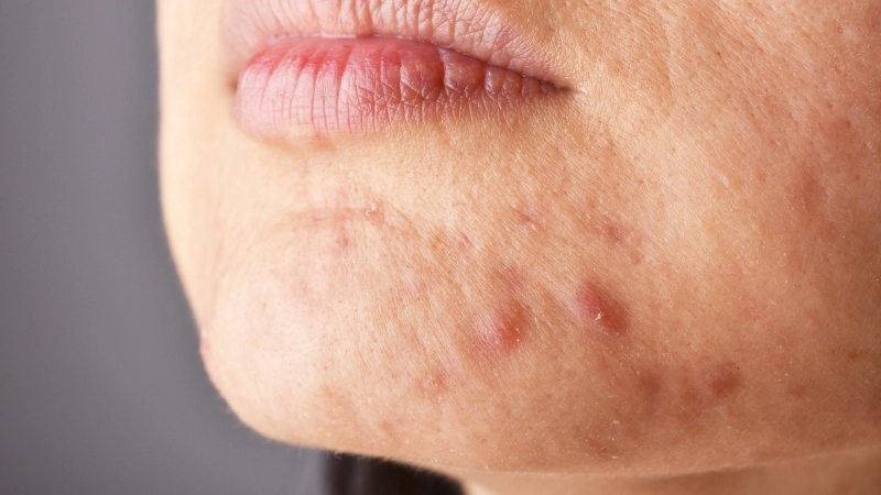 Da tiết quá nhiều dầu và gây ra mụn