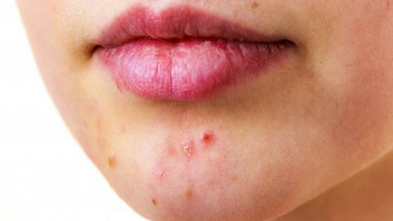 Cách cải thiện tình trạng nổi mụn ở cằm hiệu quả