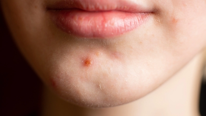 Nổi mụn ở cằm phản ánh da đang mất cân bằng