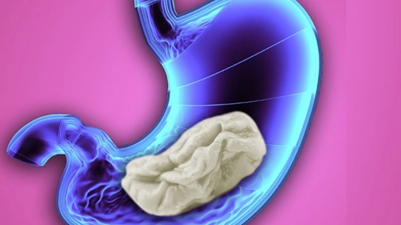 Triệu chứng khi bị nuốt singum