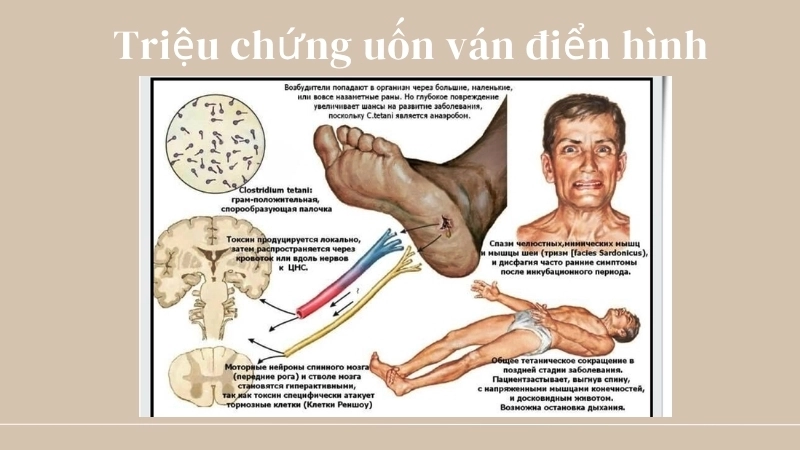  Triệu chứng uốn ván điển hình là cứng hàm, co giật cơ và cong người