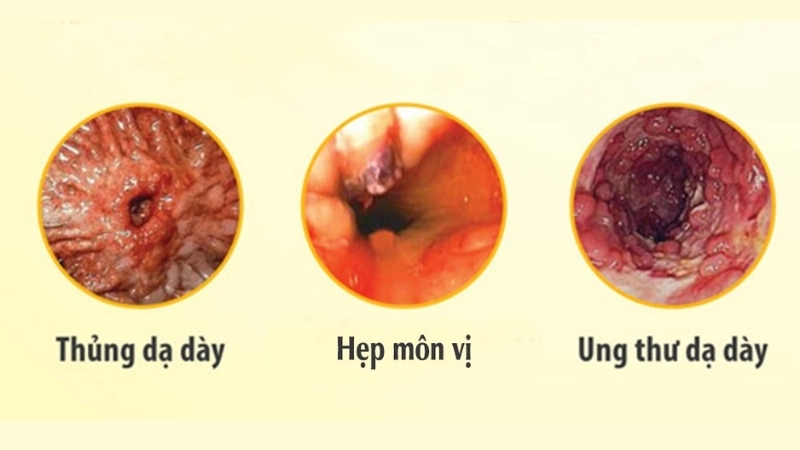 Viêm dạ dày hp có bị sao không?