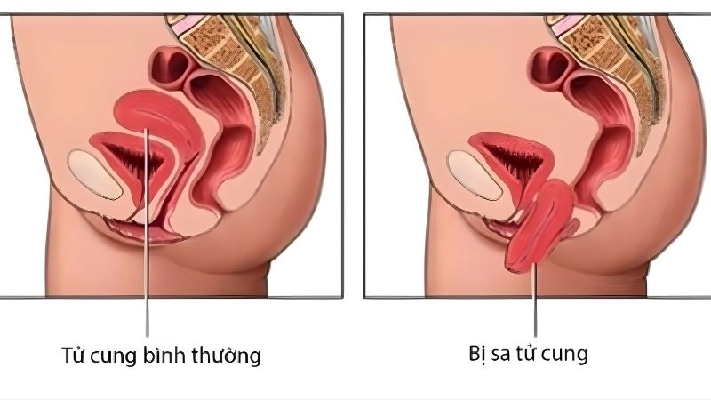 Hướng dẫn tự kiểm tra sa tử cung bằng tay – 4 bước siêu dễ nhớ