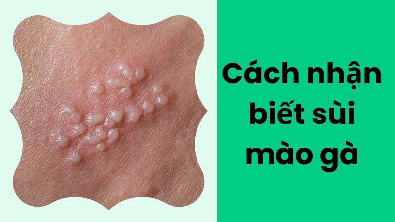 Cách nhận biết sùi mào gà với dấu hiệu sớm dễ bỏ qua