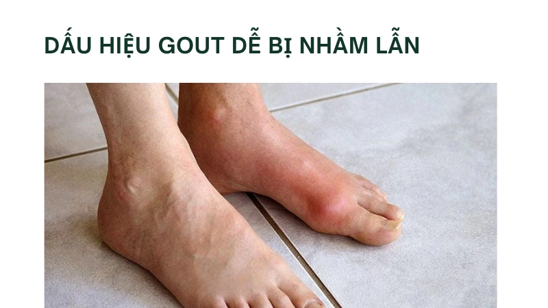 Cách nhận biết bệnh gout từ dấu hiệu sớm để điều trị kịp thời