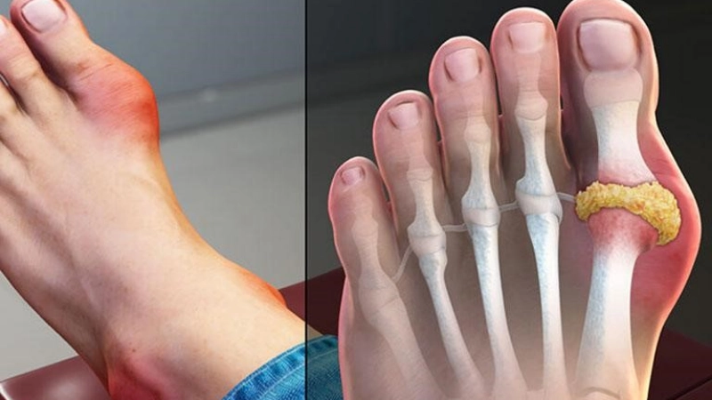 Gout thường khởi phát vào thời điểm nào?