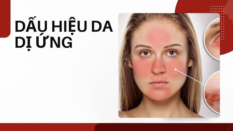 Da mặt mẩn đỏ, ngứa ngáy- Cách tôi phân biệt và xử lý