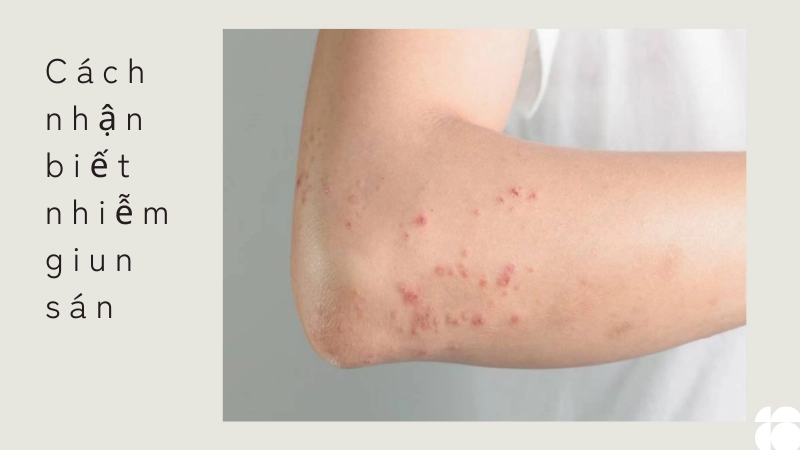 Dấu hiệu nhiễm giun sán và cách nhận biết và khi nào cần tẩy