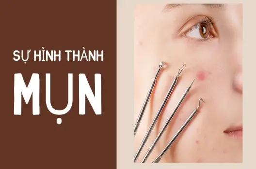 Mụn được hình thành như thế nào? Giải mã quá trình phức tạp trên da