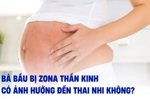 Bầu bị zona có sao không và cách xử lý an toàn