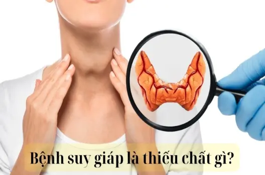 Bệnh suy giáp là thiếu chất gì và cách bổ sung hiệu quả