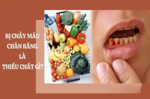 Bị chảy máu chân răng là thiếu chất gì và điều trị ra sao