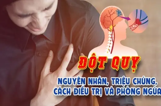 Bị đột quỵ có sao không và cách nhận biết sớm triệu chứng