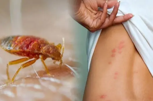 Bị gián cắn có sao không và triệu chứng cảnh báo nguy hiểm
