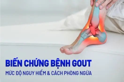 Bị gút có sao không và cách phòng ngừa hiệu quả