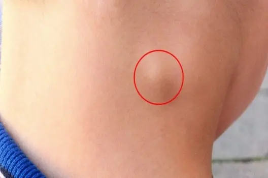 Bị hạch có sao không và khi nào cần đi khám ngay