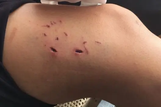 Bị heo cắn có sao không và cách xử lý đúng cách