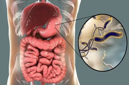 Bị hp có sao không? Dấu hiệu và biến chứng cần biết