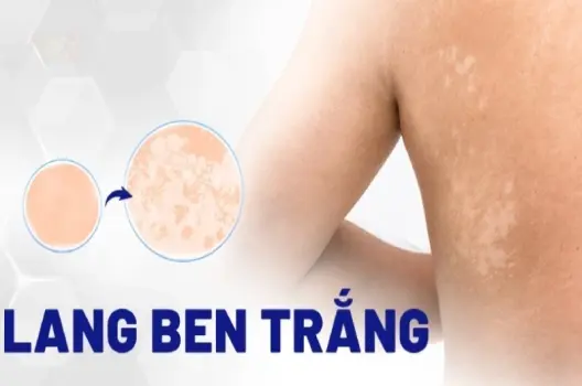 Bị lang ben có sao không và có nên điều trị sớm