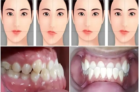 Bị lệch hàm có sao không và cách khắc phục hiệu quả
