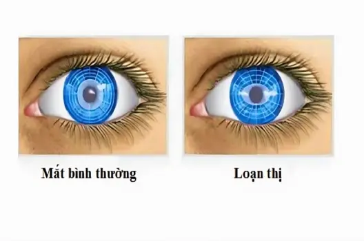 Bị loạn thị có sao không và triệu chứng nhận biết sớm