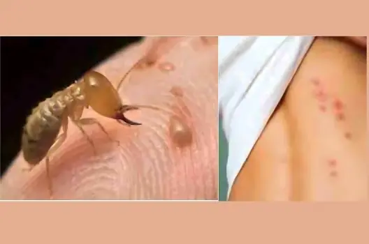 Bị mối cắn có sao không và cách xử lý đúng cách