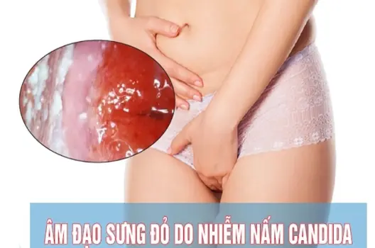 Bị nấm candida có sao không và cách điều trị hiệu quả