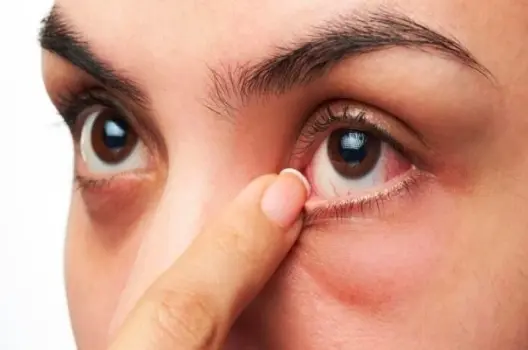 Bị ngứa mắt có sao không và cách xử lý hiệu quả