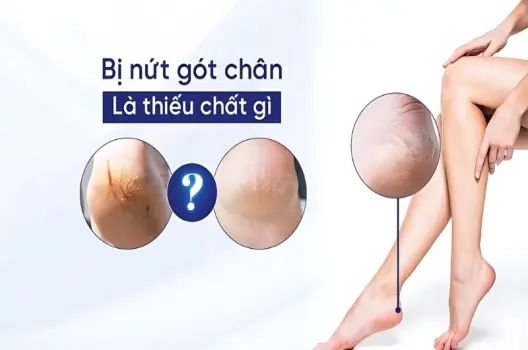 Bị nứt gót chân là thiếu chất gì và dấu hiệu đi kèm